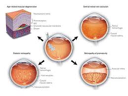Võng mạc ở trẻ sinh non - Hình ảnh minh họa